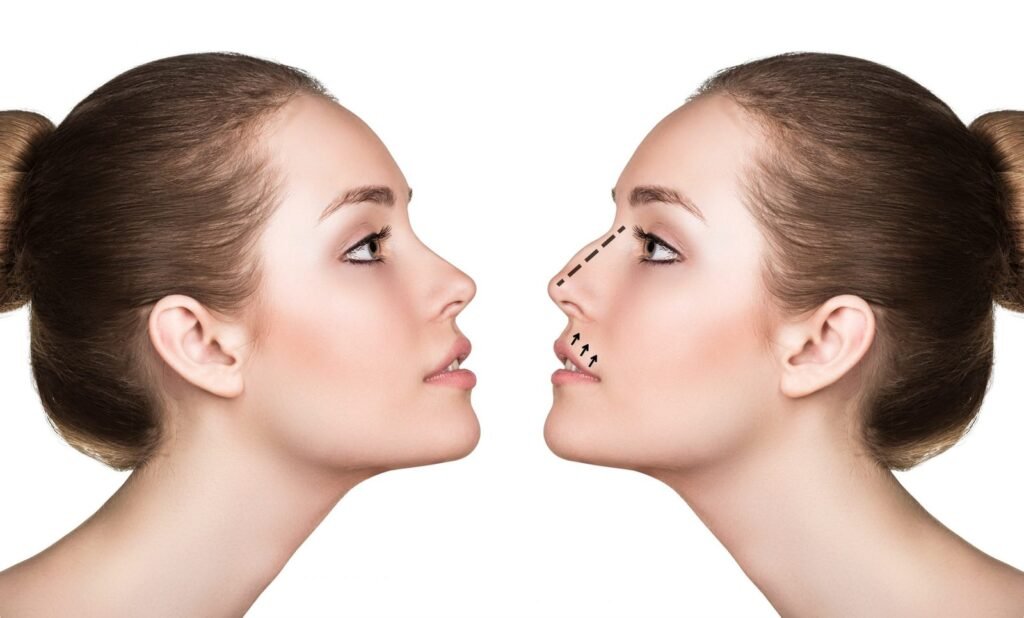 What you should know about non-surgical nose job