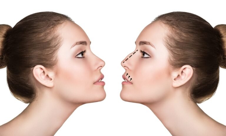 What you should know about non-surgical nose job