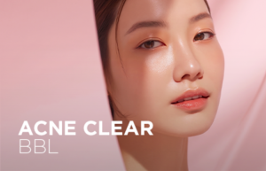 Acne Clear BBL BroadBand Light treatment for acne at SW1 Clinic Singapore