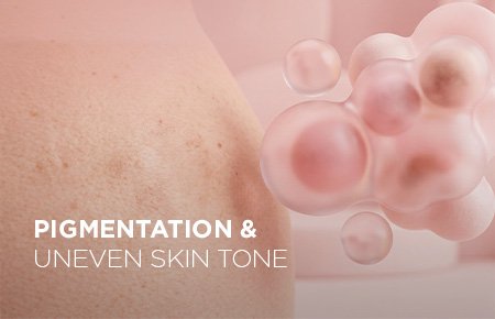SW1 Clinic pigmentation and uneven skin tone thumbnail